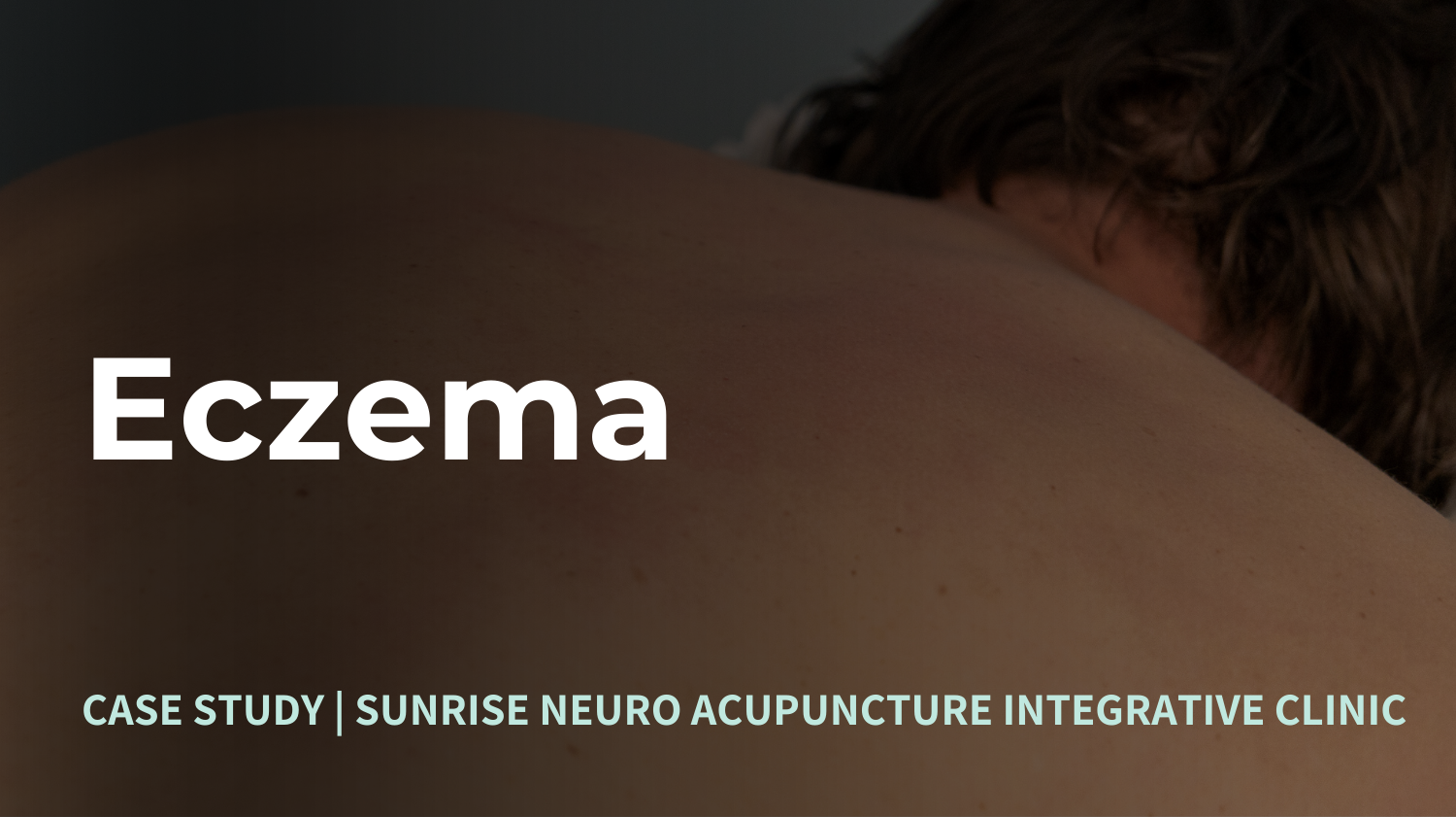 Eczema Treatment Sunrise Neuro Acupuncture Clinic